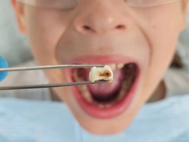 Best Dental Abscess Treatment in Alamo, CA